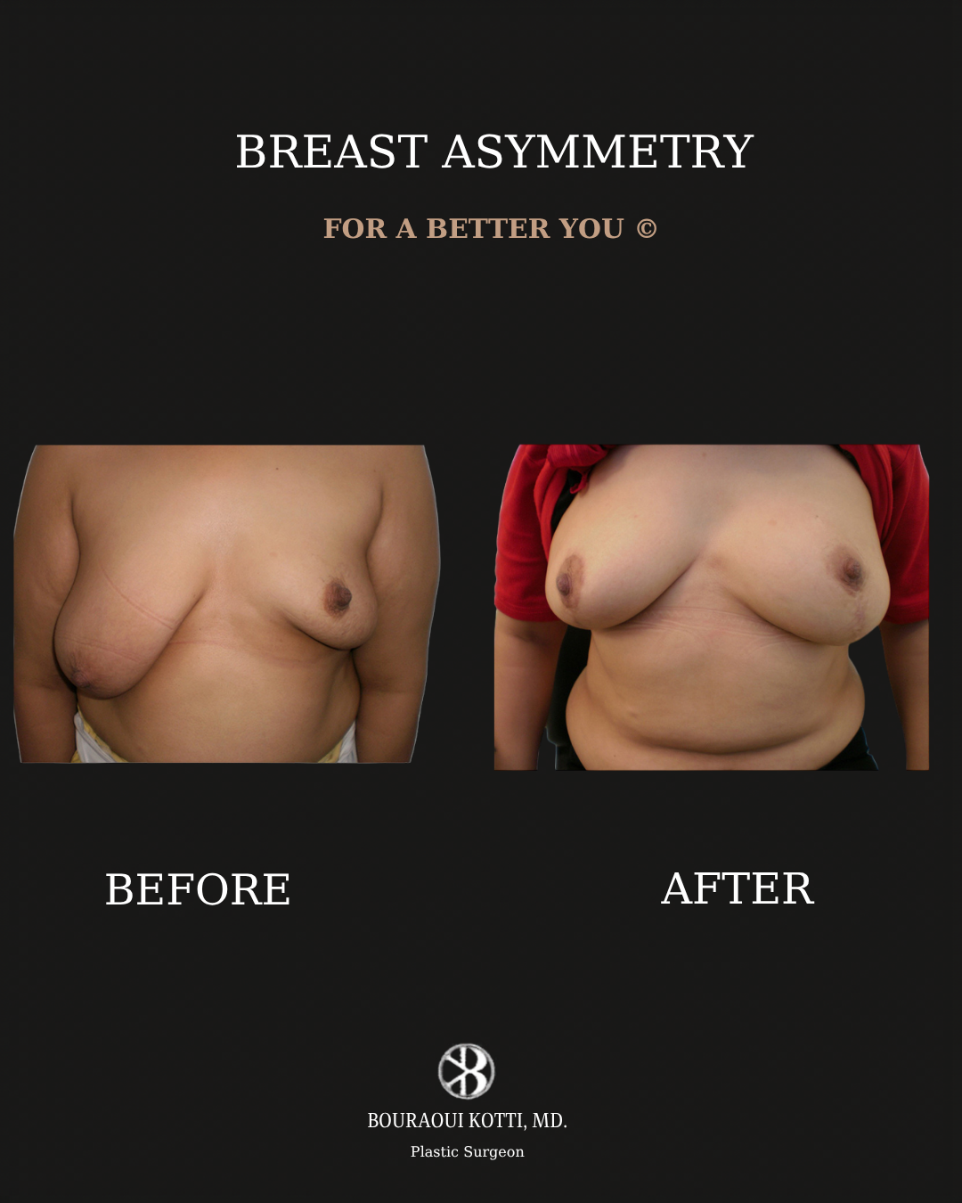 Коррекция асимметрии груди before and after clinical result