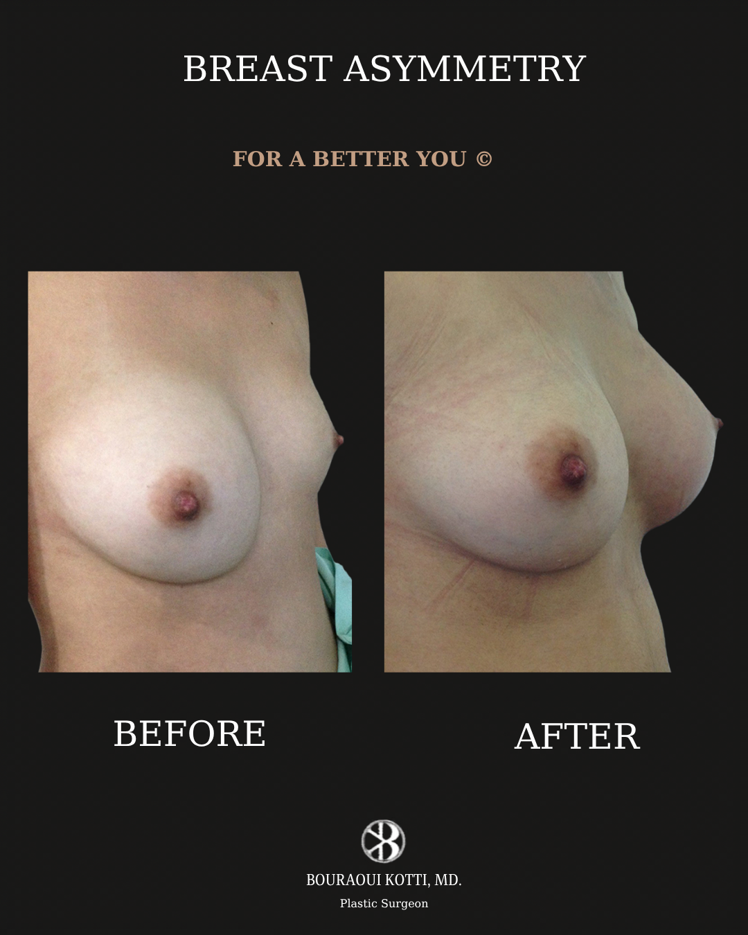Коррекция асимметрии груди before and after clinical result