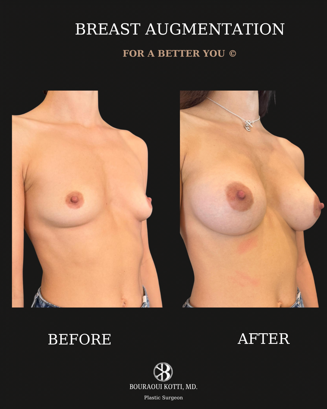 Breast Augmentation before and after clinical result