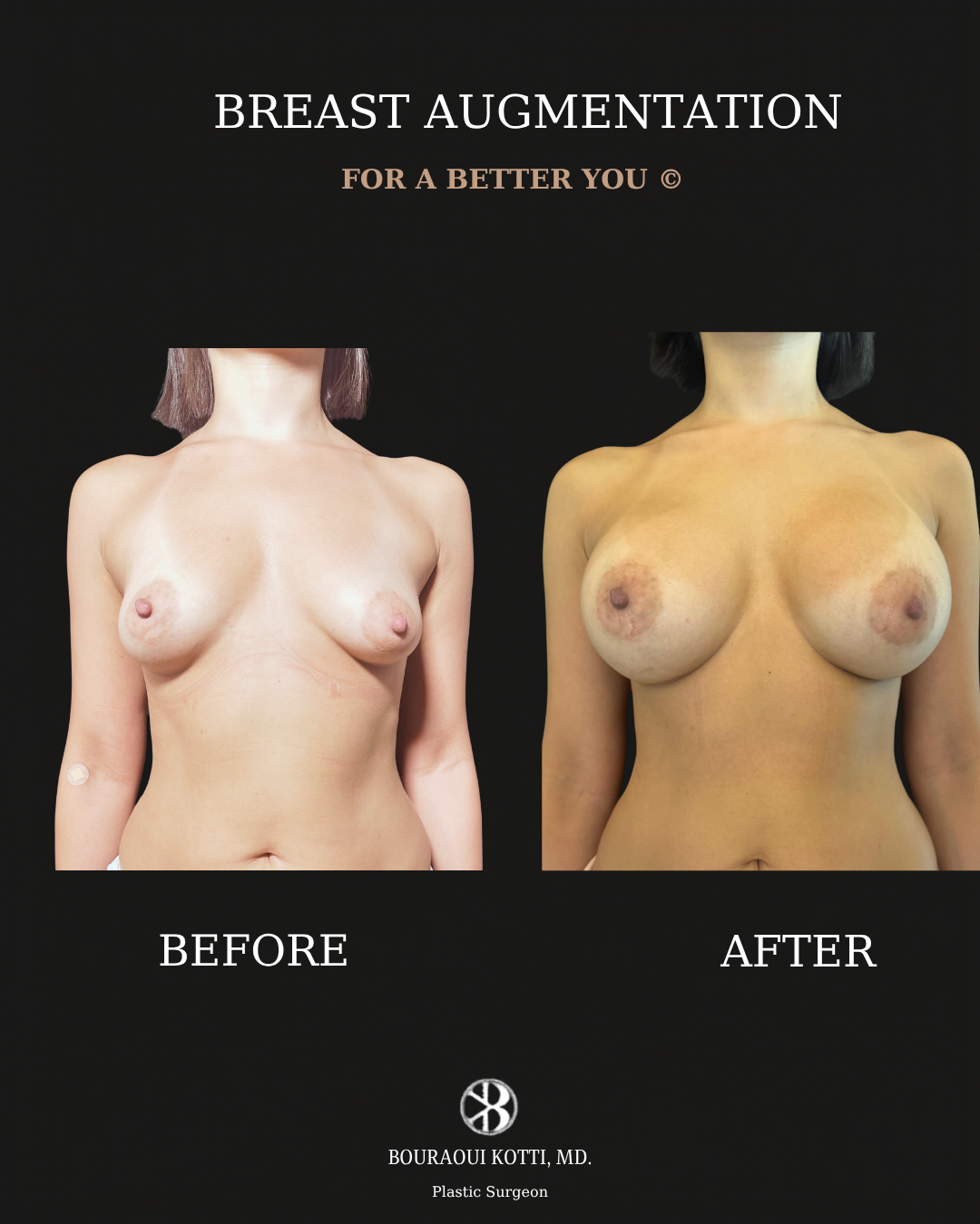 Breast Augmentation before and after clinical result