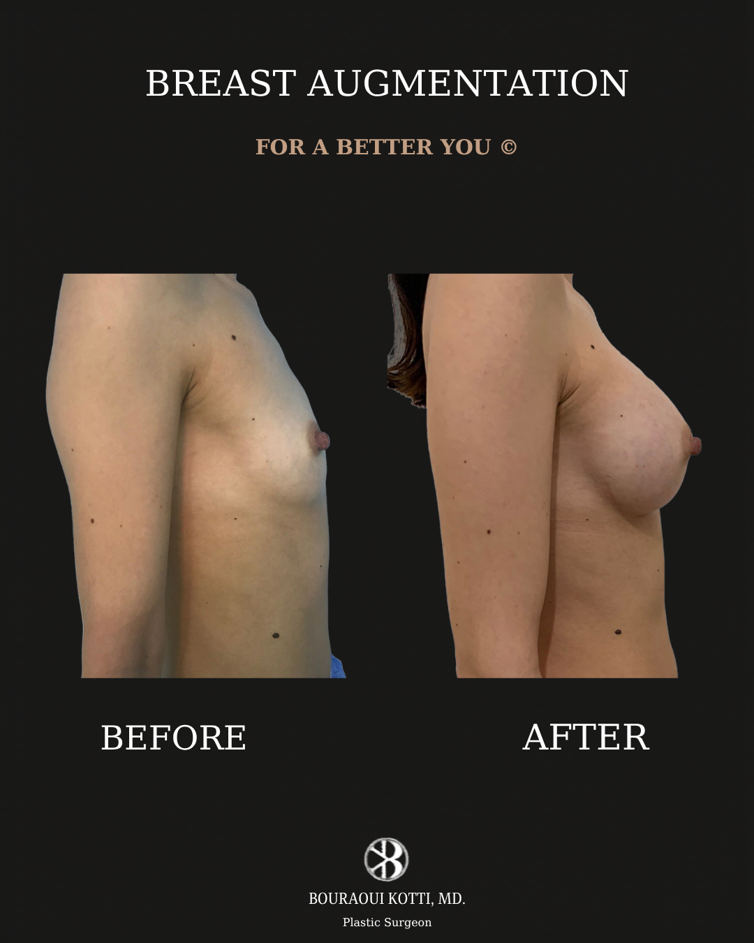 Breast Augmentation before and after clinical result