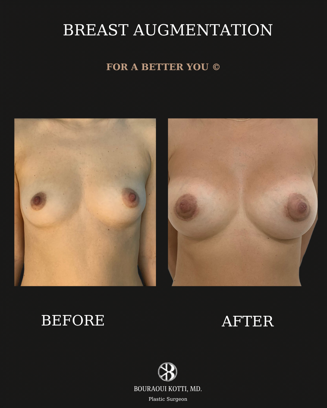 Breast Augmentation before and after clinical result