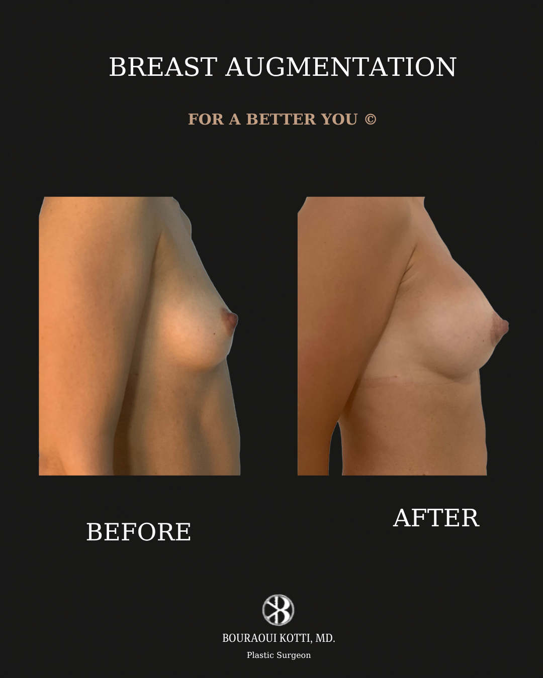 Breast Augmentation before and after clinical result