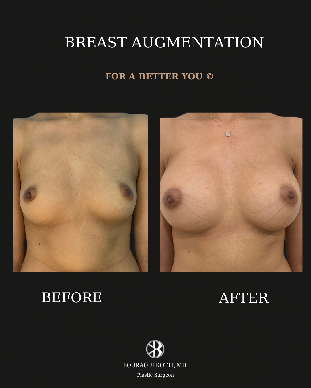 Breast Augmentation before and after clinical result