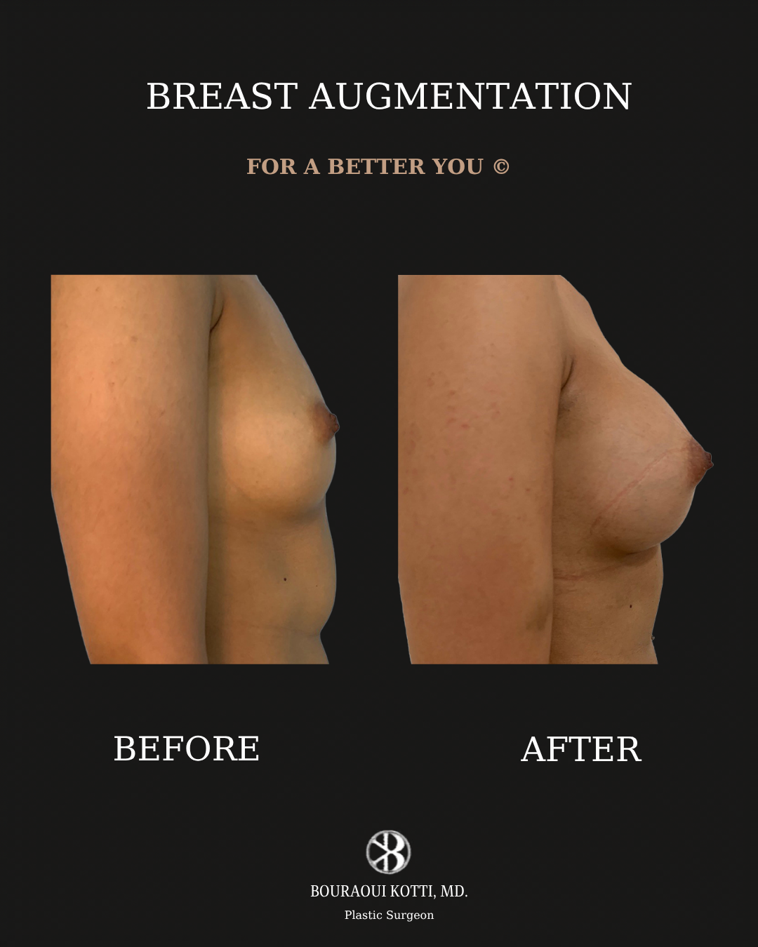Breast Augmentation before and after clinical result