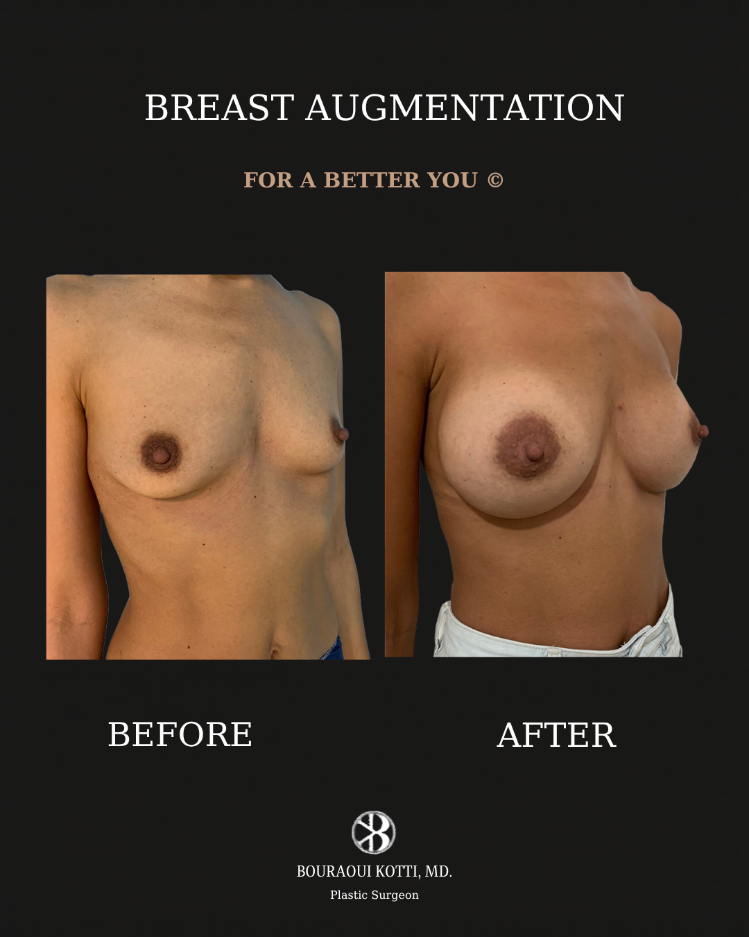 Breast Augmentation before and after clinical result