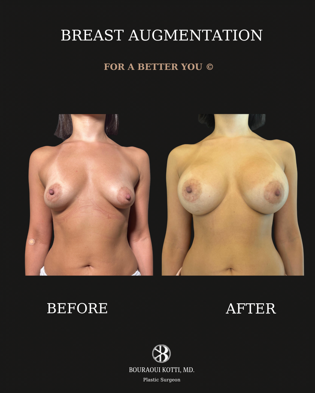 Breast Augmentation before and after clinical result