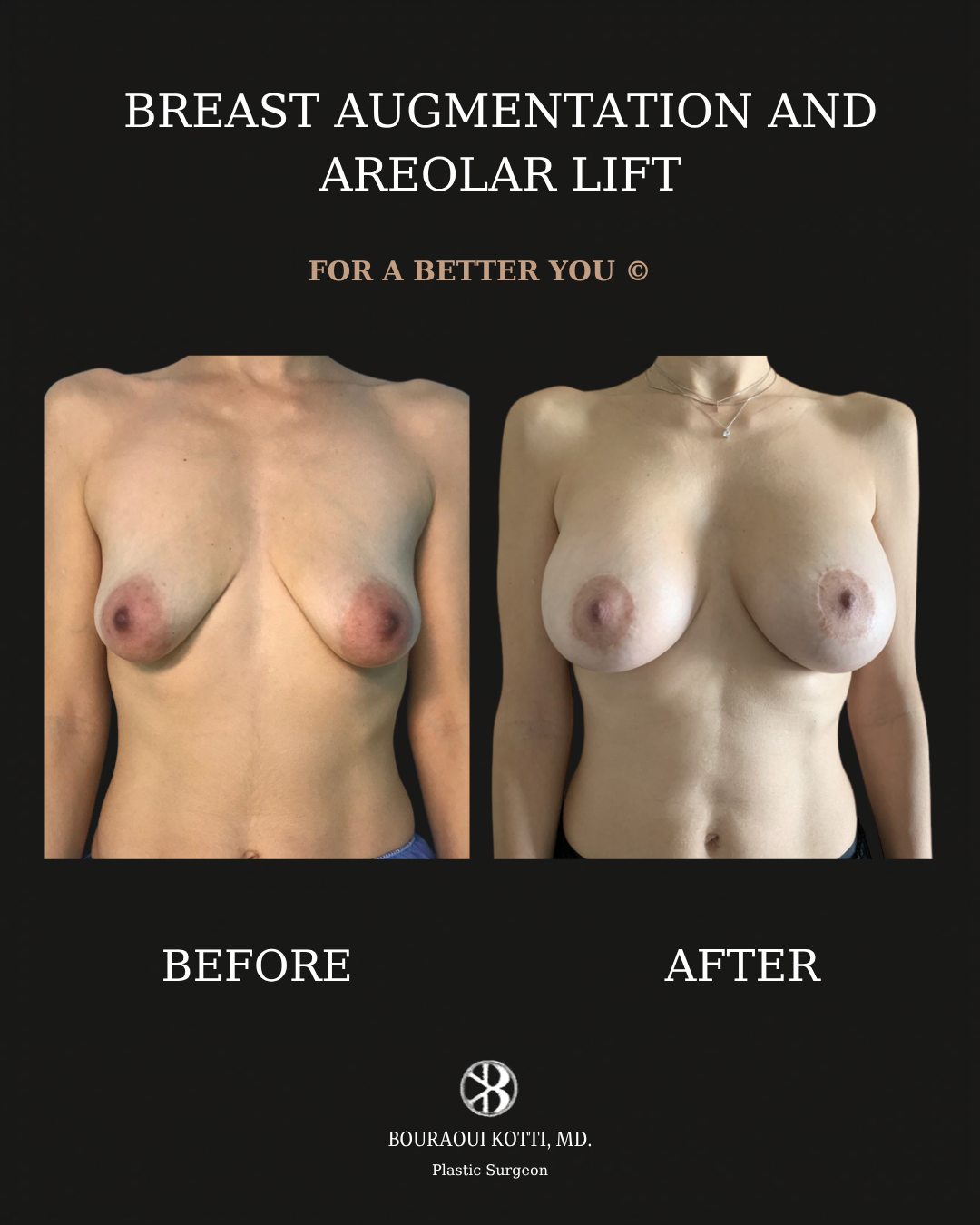 Breast Augmentation before and after clinical result