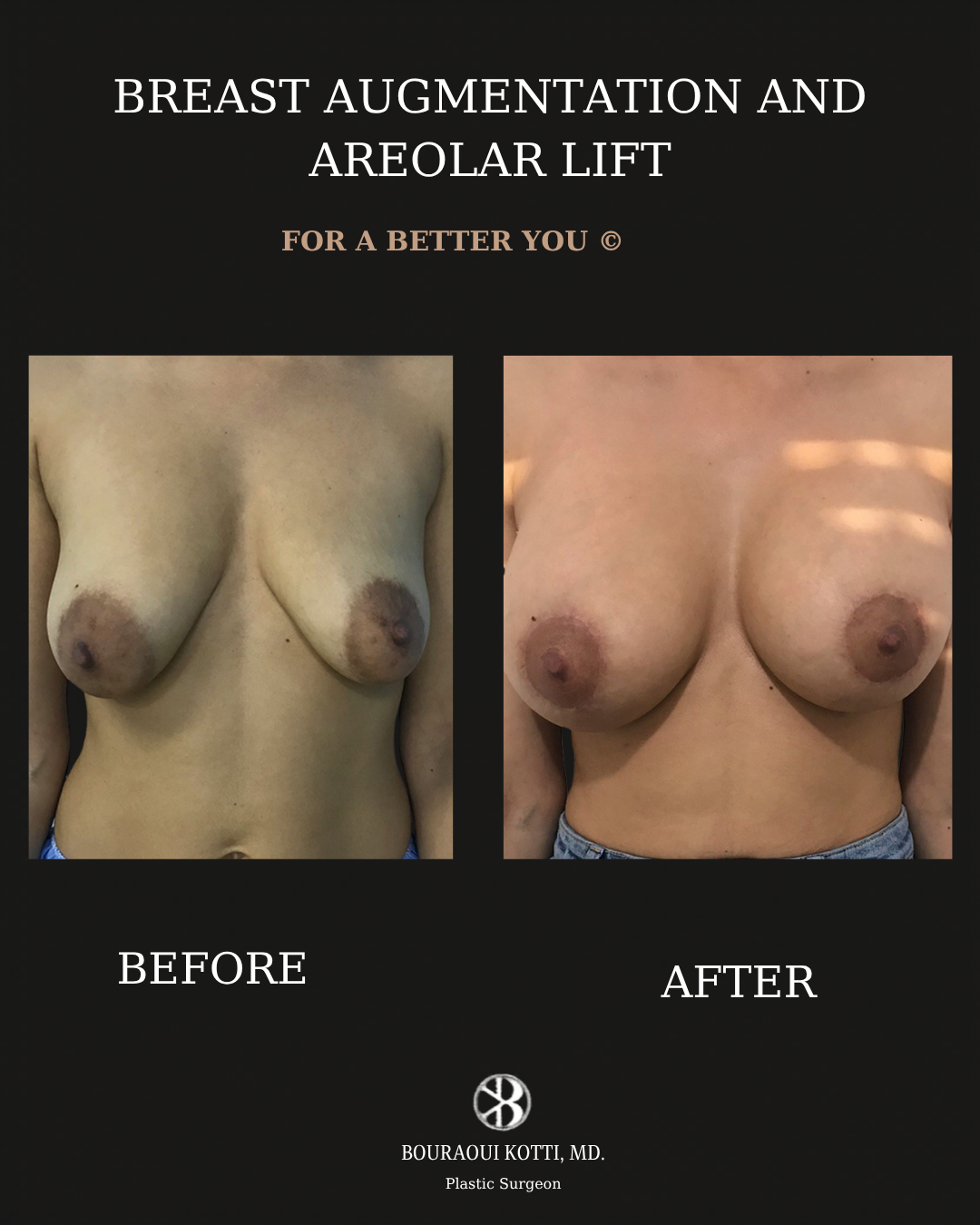 Breast Augmentation before and after clinical result