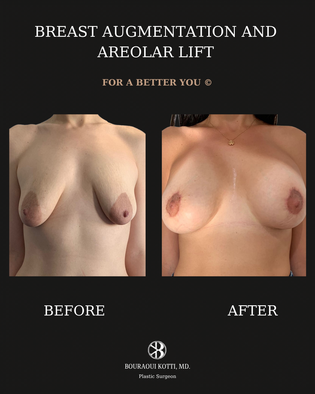 Breast Augmentation before and after clinical result
