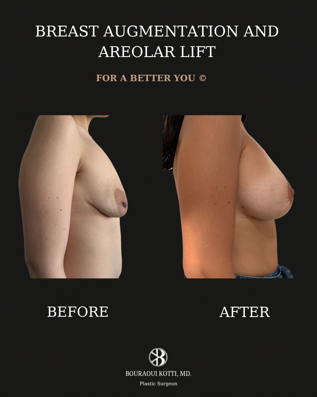 Breast Augmentation before and after clinical result