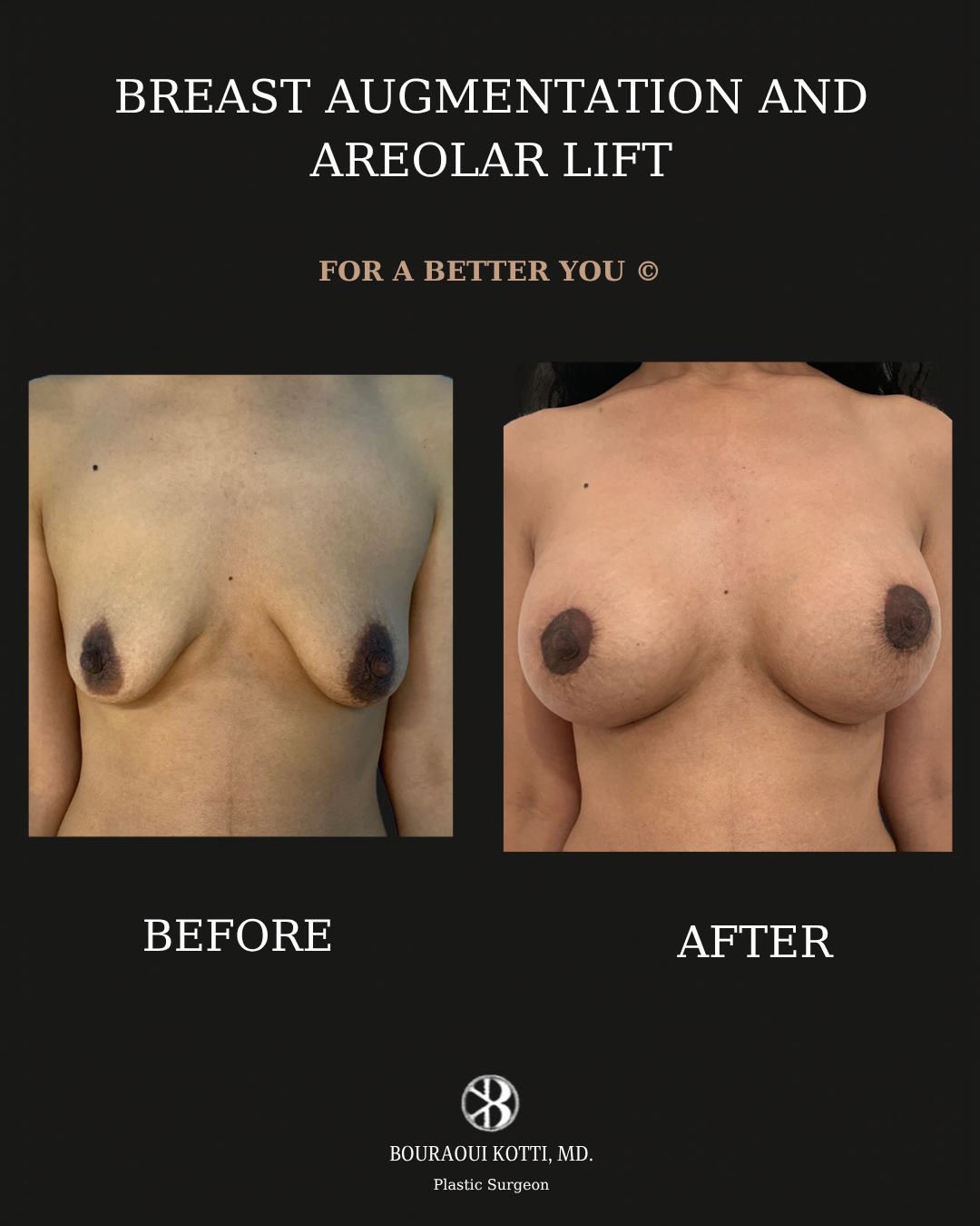 Breast Augmentation before and after clinical result