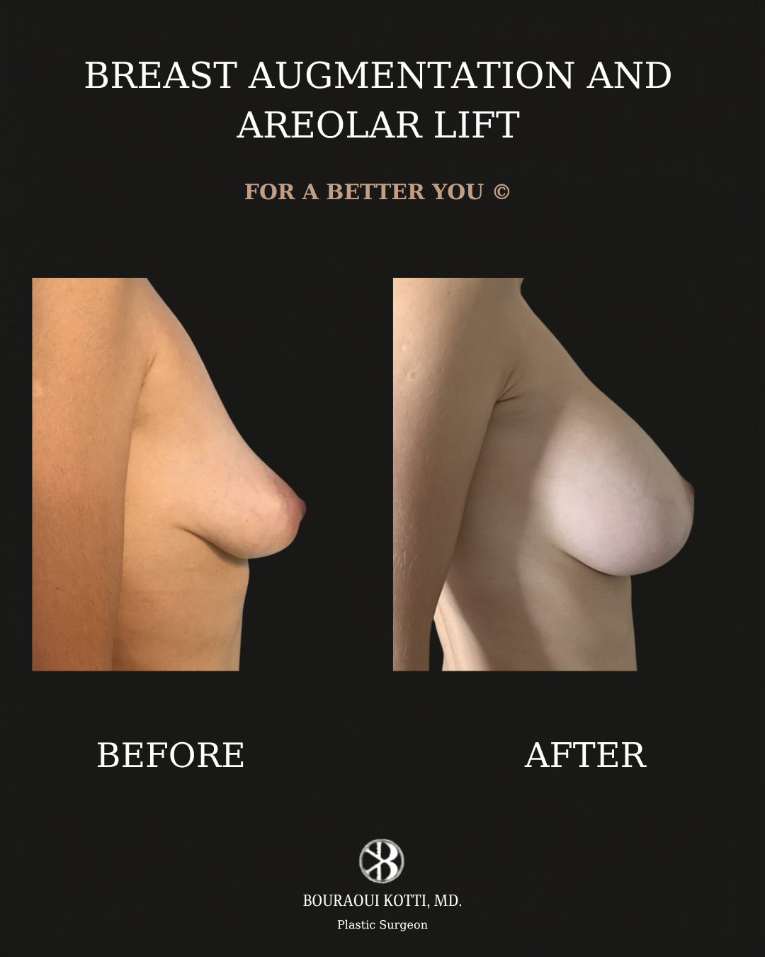 Breast Augmentation before and after clinical result