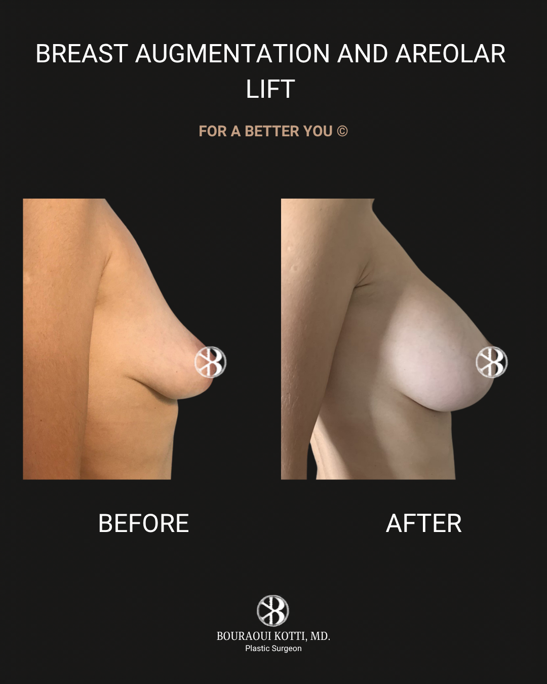 Breast Augmentation before and after clinical result