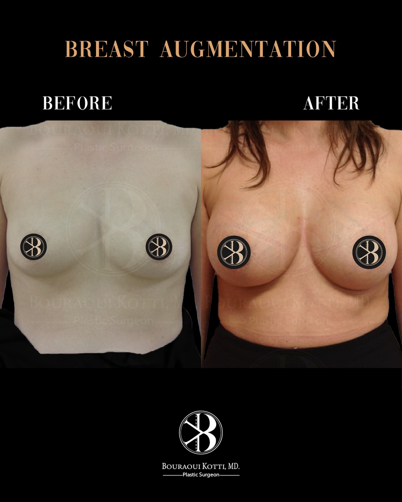 Breast Augmentation before and after clinical result