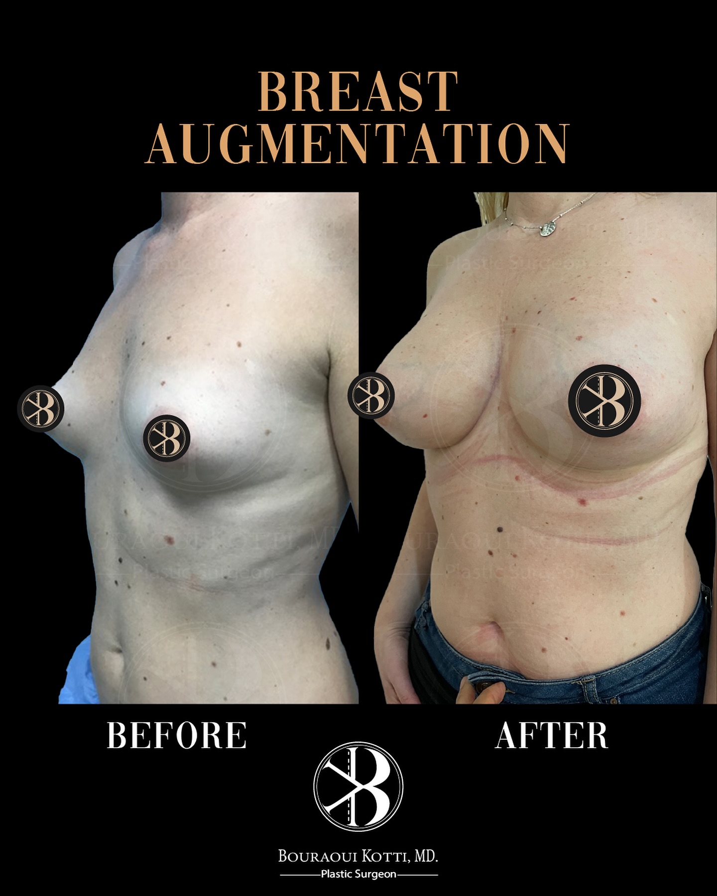 Breast Augmentation before and after clinical result