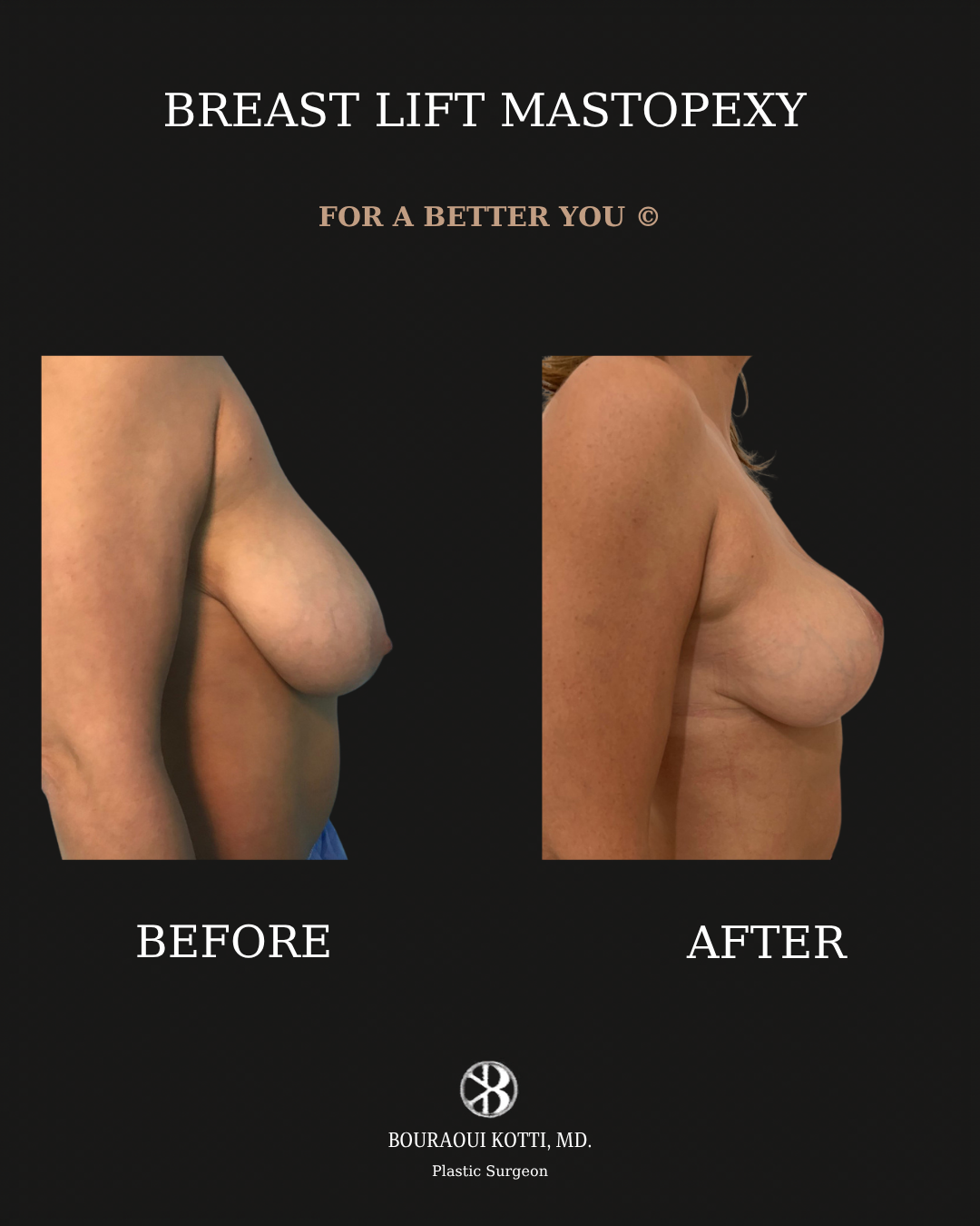 Breast Lift and Mastopexy before and after clinical result