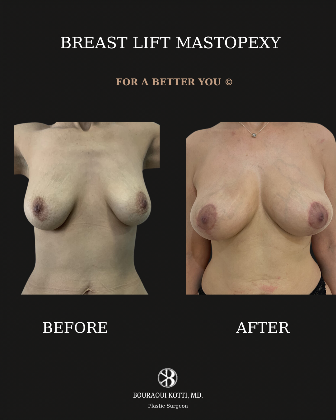 Breast Lift and Mastopexy before and after clinical result