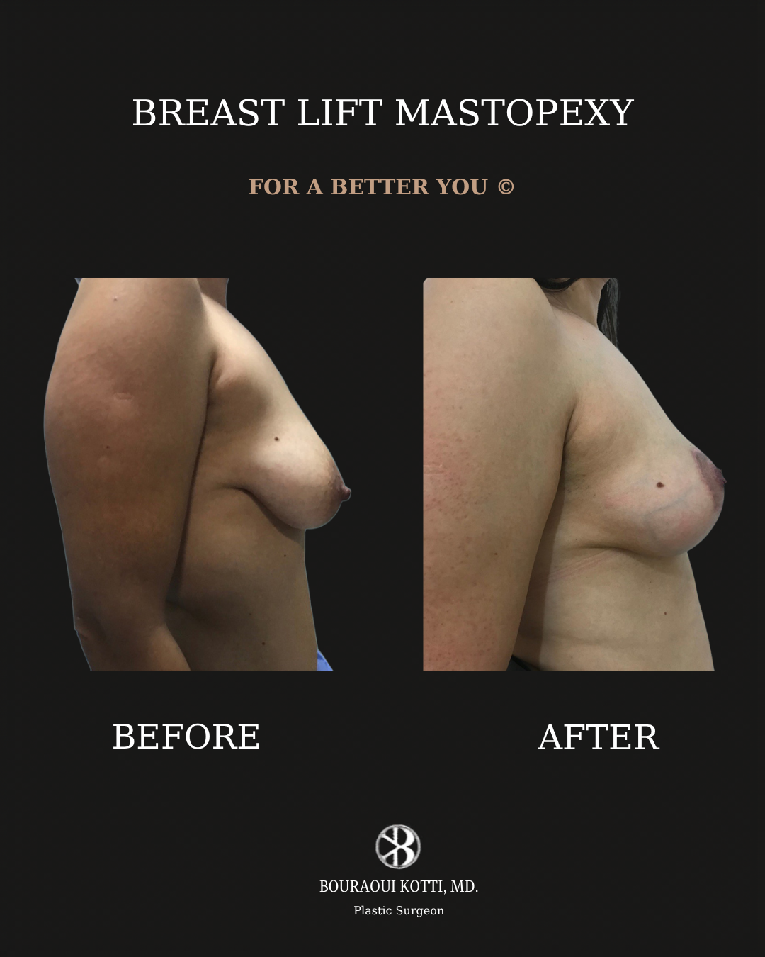 Breast Lift and Mastopexy before and after clinical result