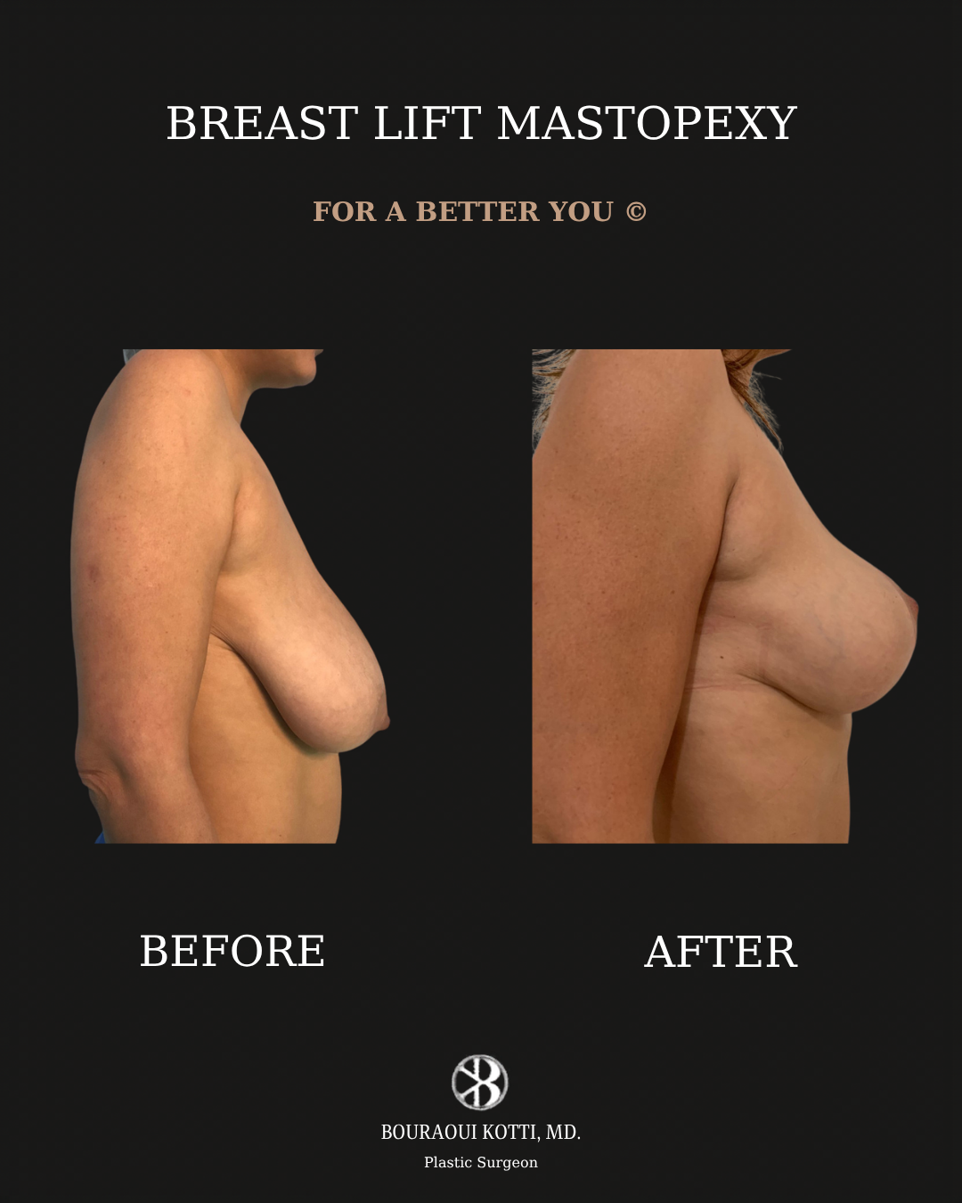 Breast Lift and Mastopexy before and after clinical result