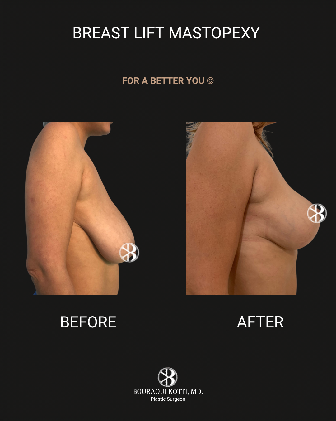 Breast Lift and Mastopexy before and after clinical result