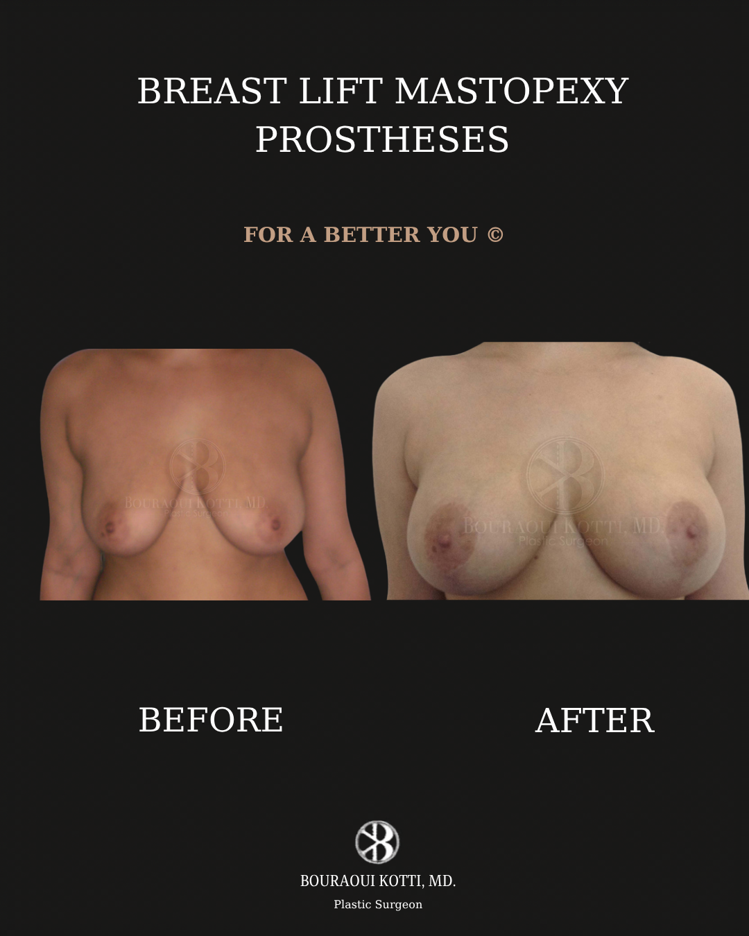 Breast Lift and Mastopexy before and after clinical result