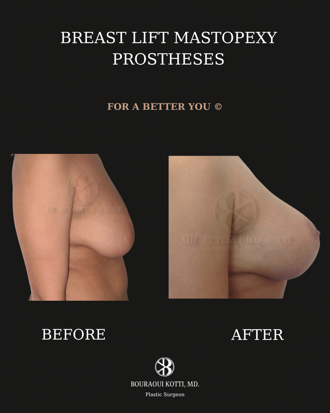 Breast Lift and Mastopexy before and after clinical result
