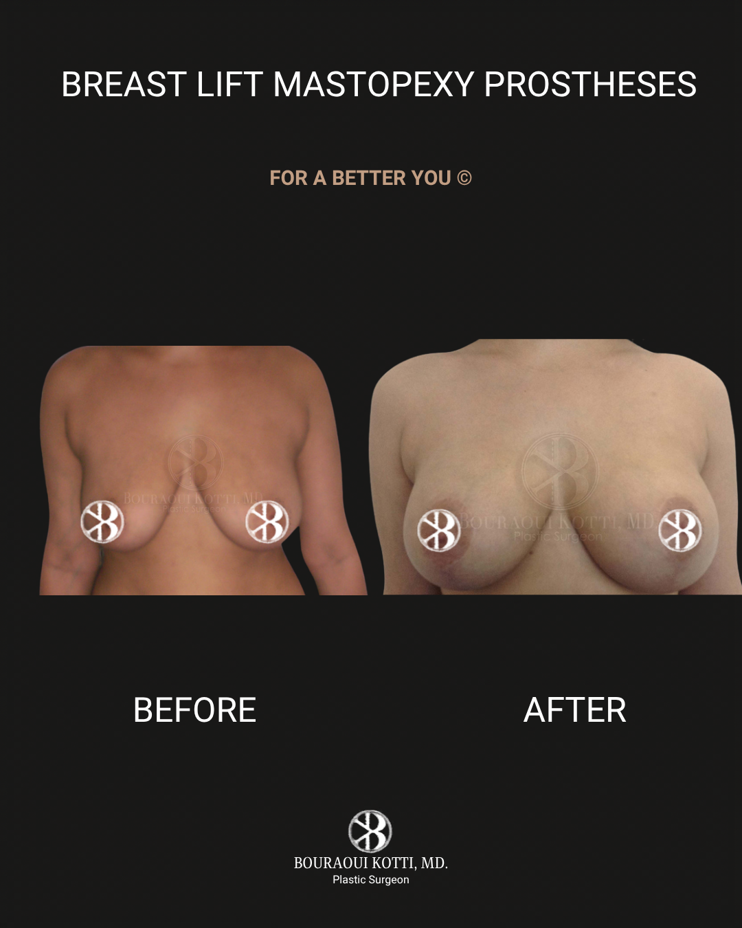 Breast Lift and Mastopexy before and after clinical result