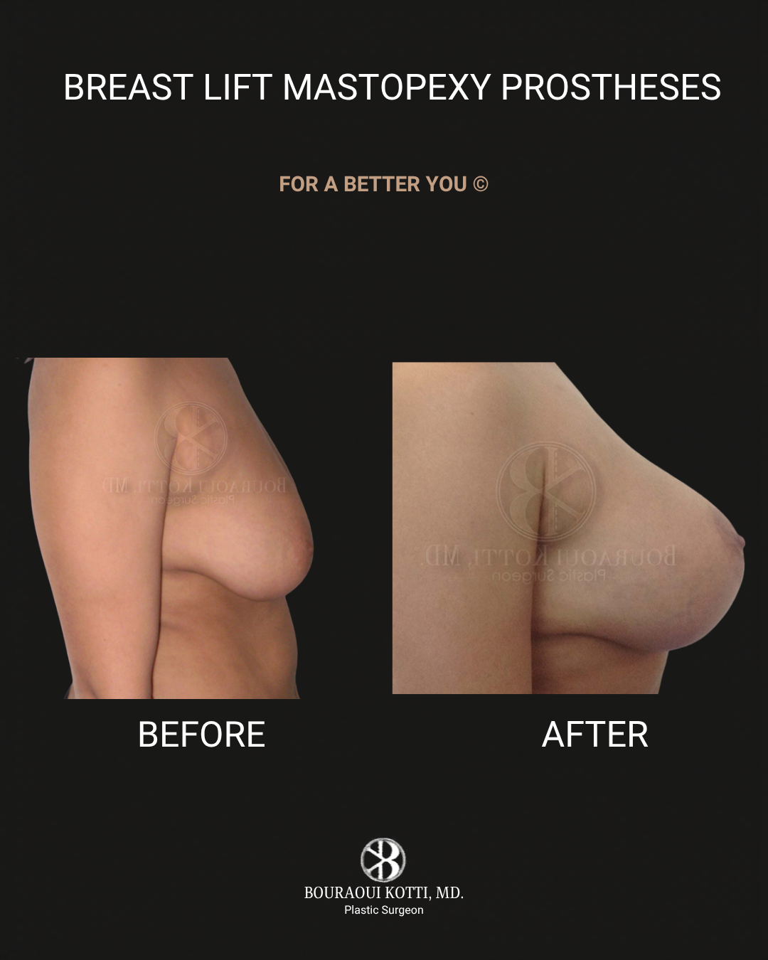 Breast Lift and Mastopexy before and after clinical result
