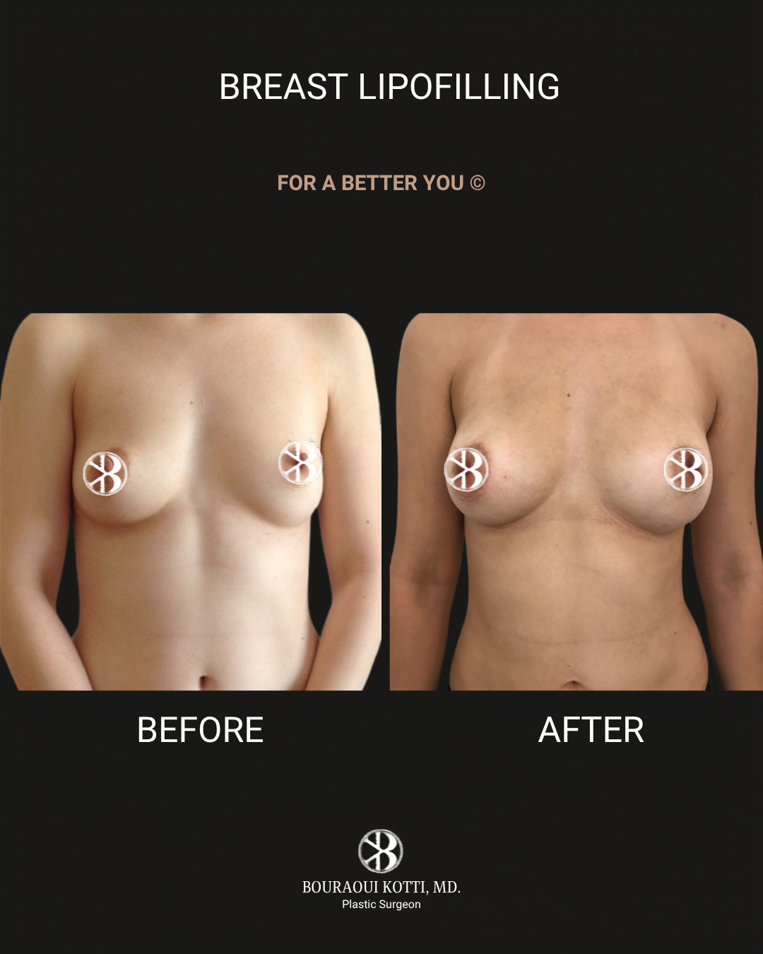 Breast Lift and Mastopexy before and after clinical result