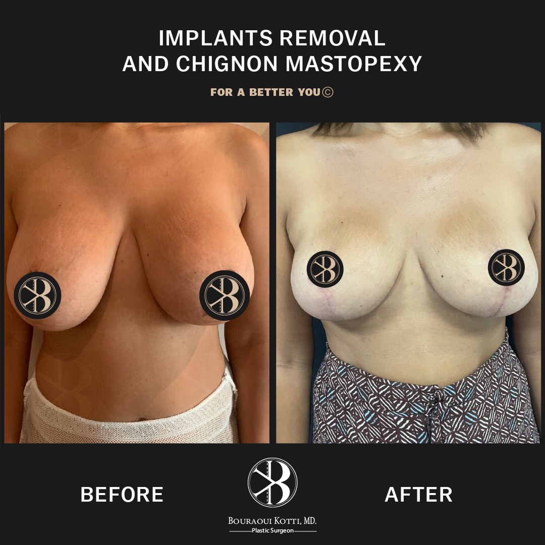 Breast Lift and Mastopexy before and after clinical result