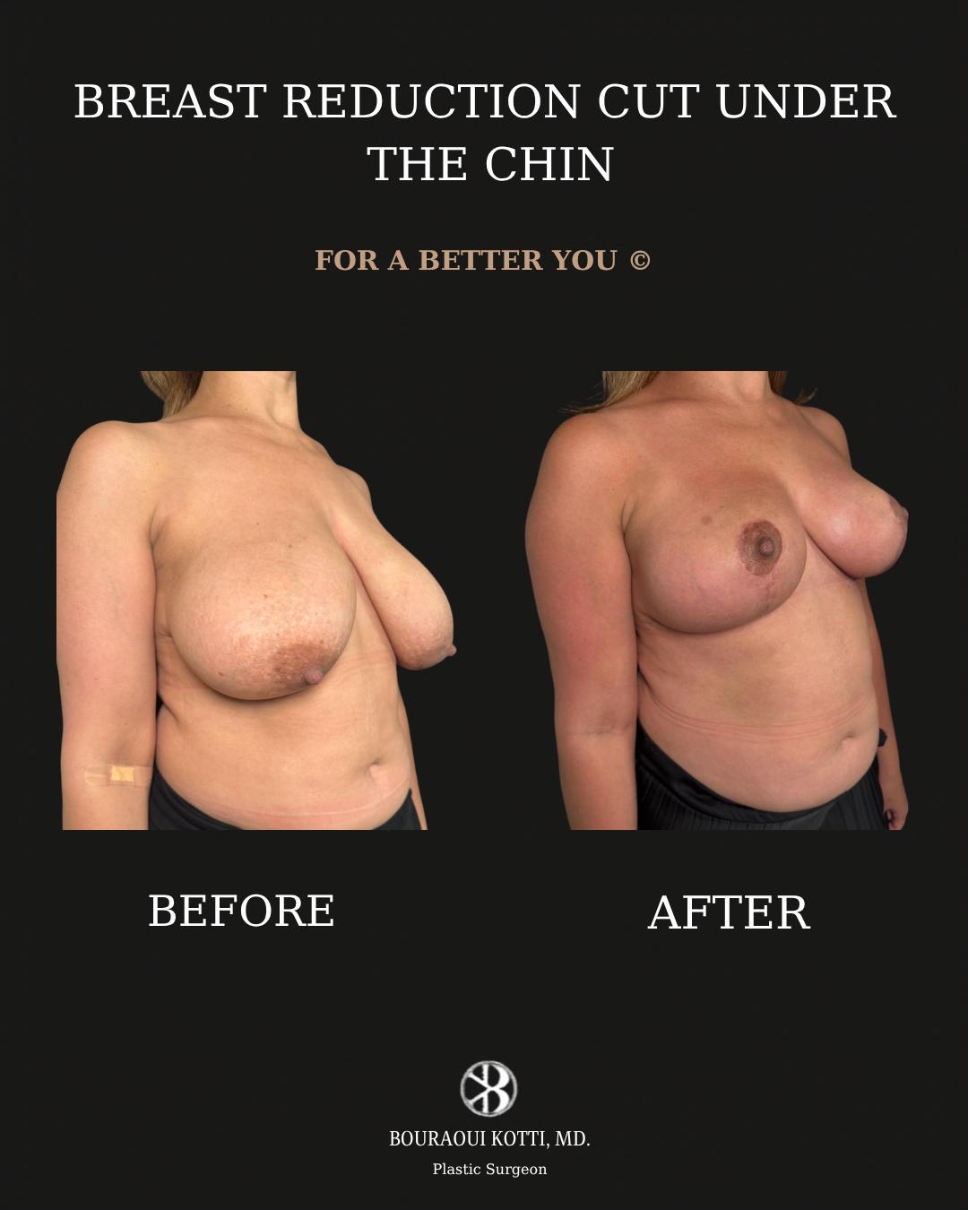 Breast Reduction Surgery in Dubai before and after clinical result