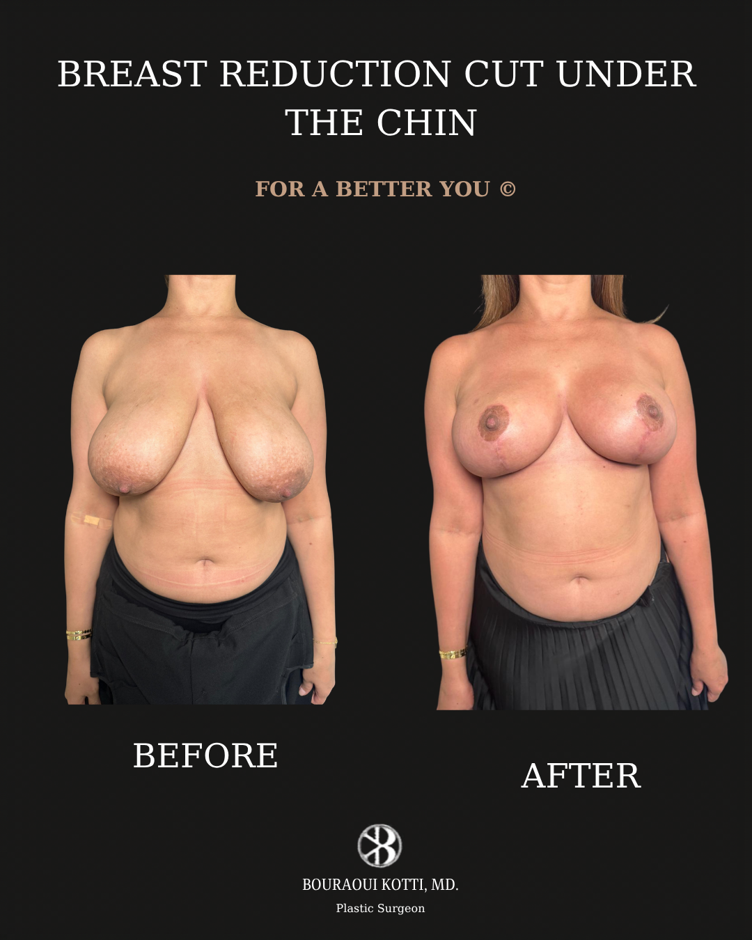 Breast Reduction Surgery in Dubai before and after clinical result