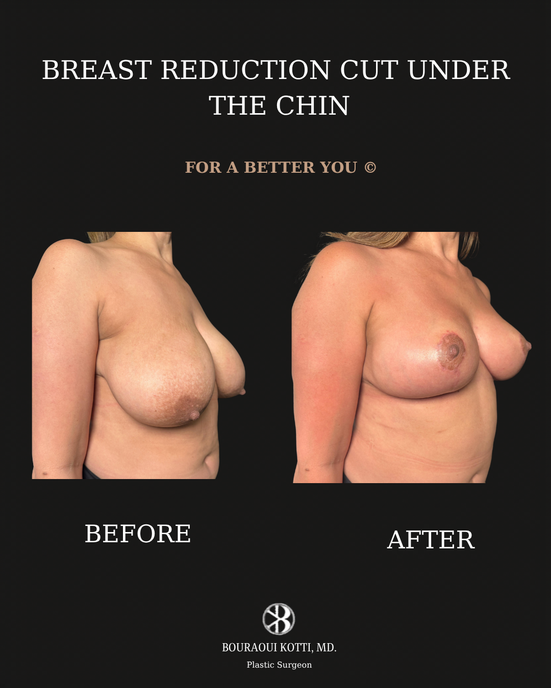 Breast Reduction Surgery in Dubai before and after clinical result