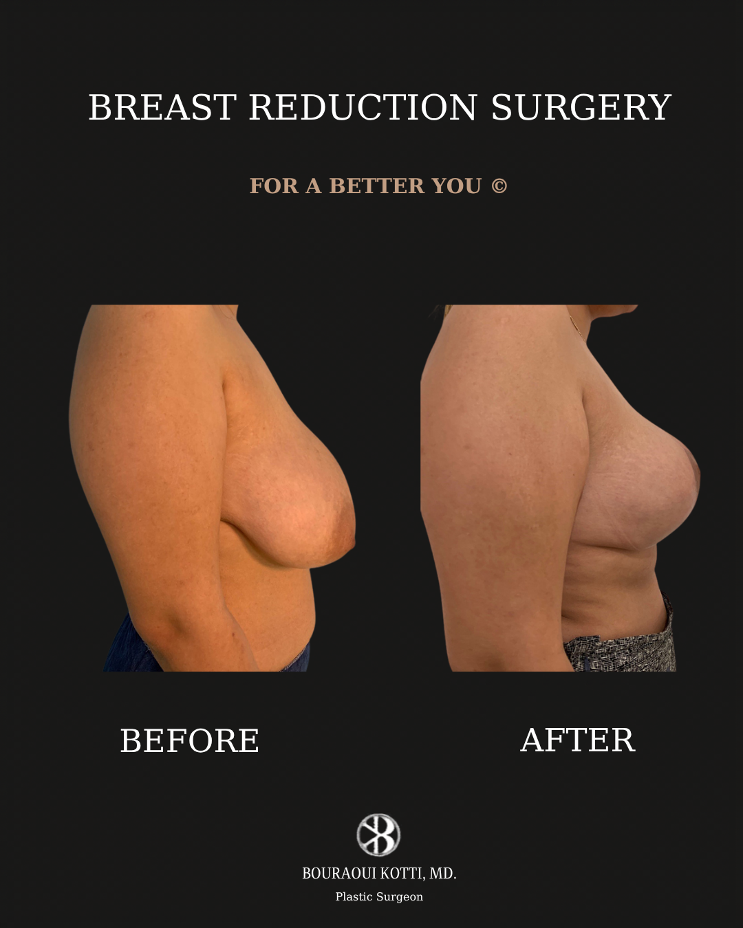Breast Reduction Surgery in Dubai before and after clinical result