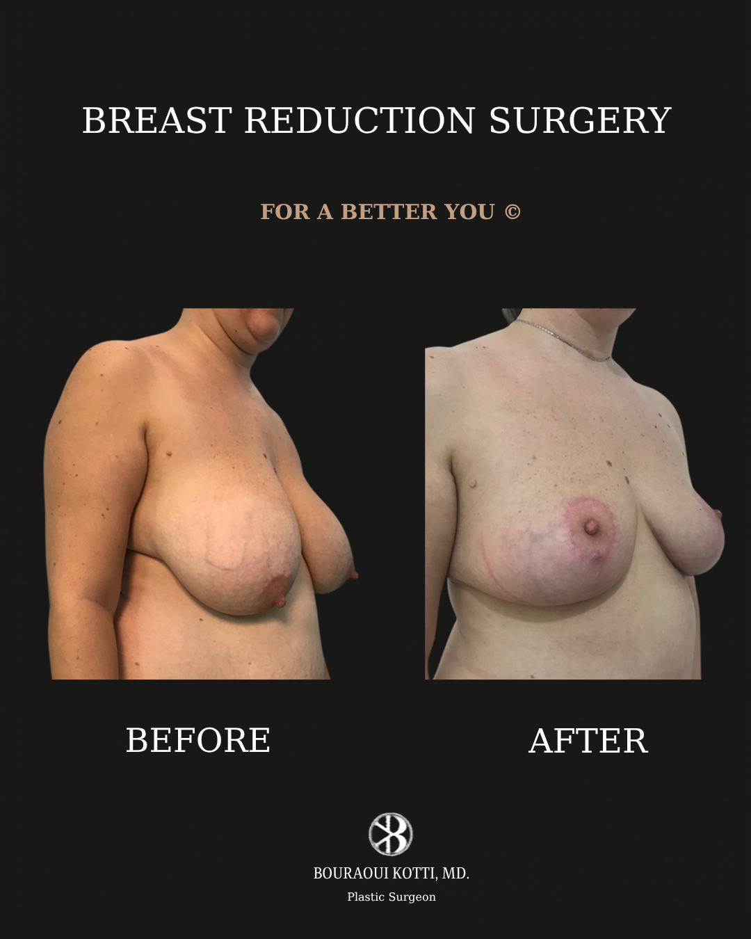 Breast Reduction Surgery in Dubai before and after clinical result