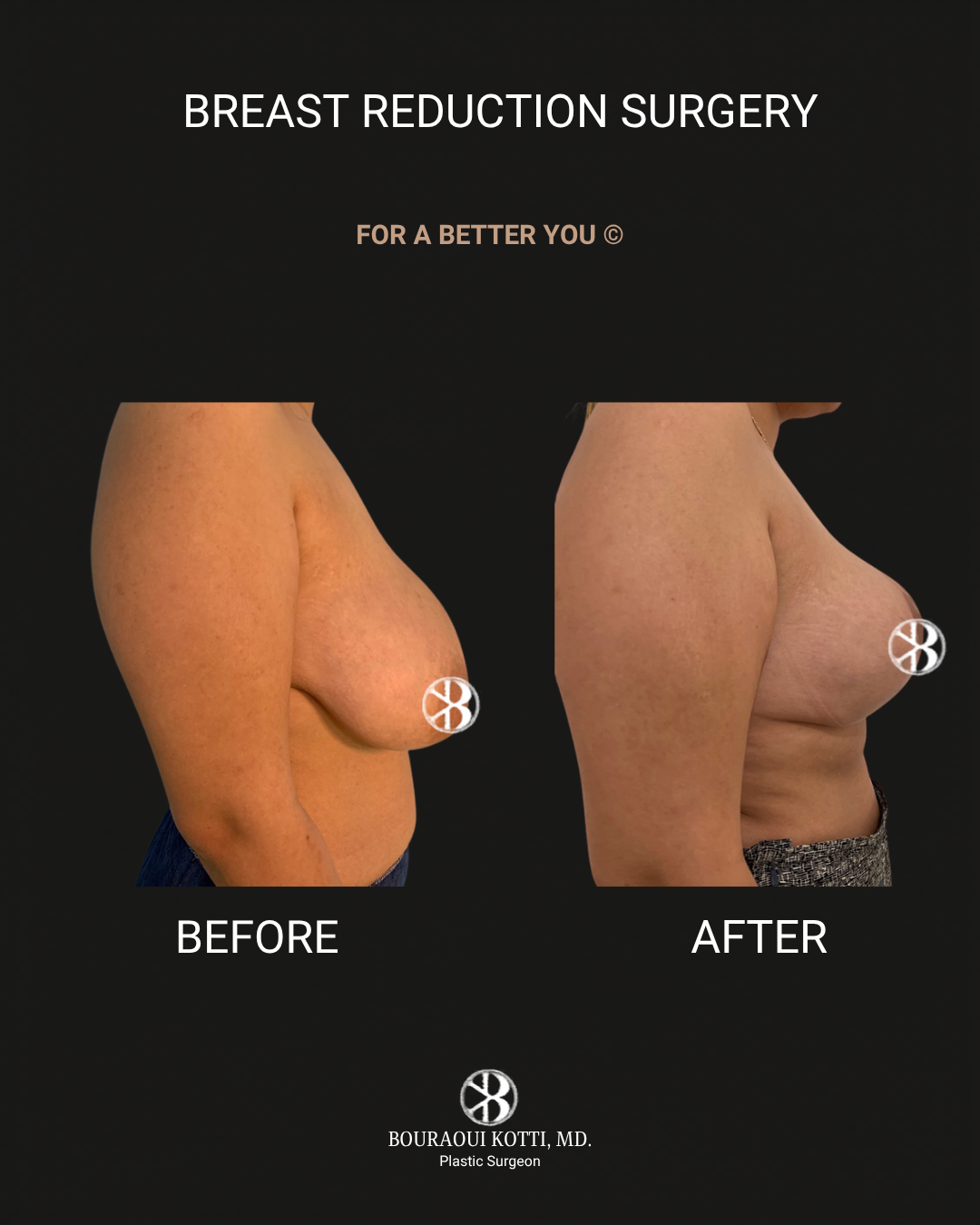 Breast Reduction Surgery in Dubai before and after clinical result