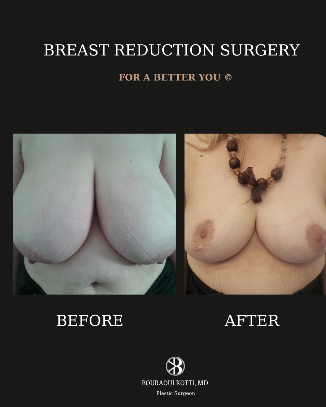 Breast Reduction Surgery in Dubai before and after clinical result