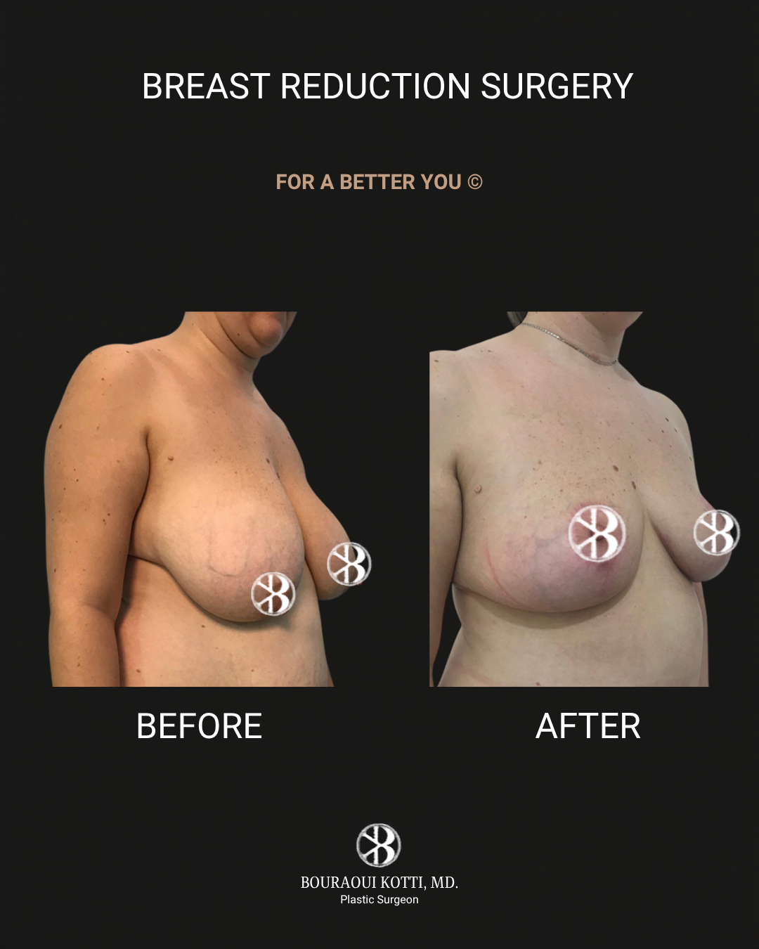 Breast Reduction Surgery in Dubai before and after clinical result