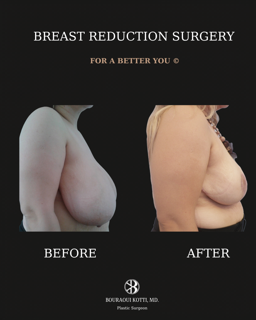 Breast Reduction Surgery in Dubai before and after clinical result