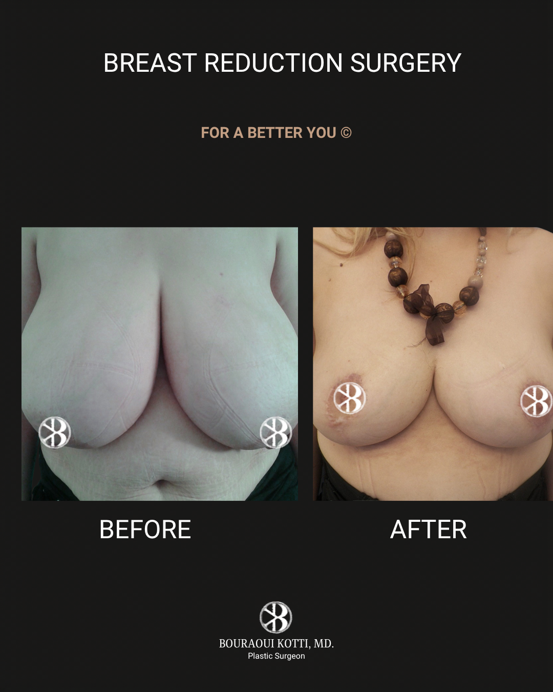 Breast Reduction Surgery in Dubai before and after clinical result