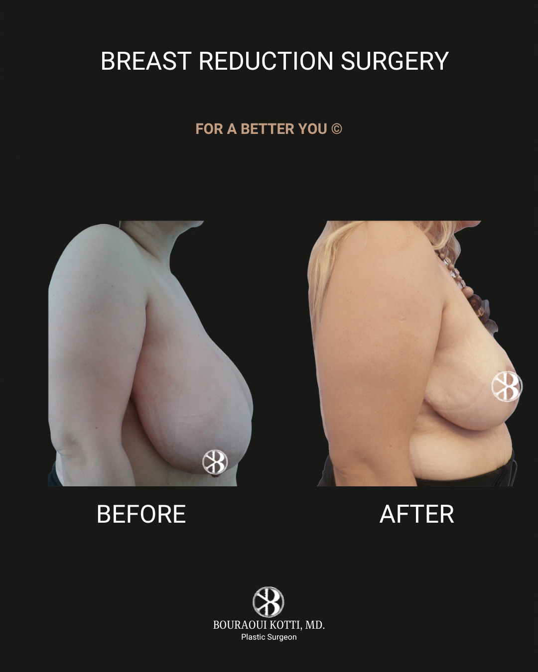 Breast Reduction Surgery in Dubai before and after clinical result