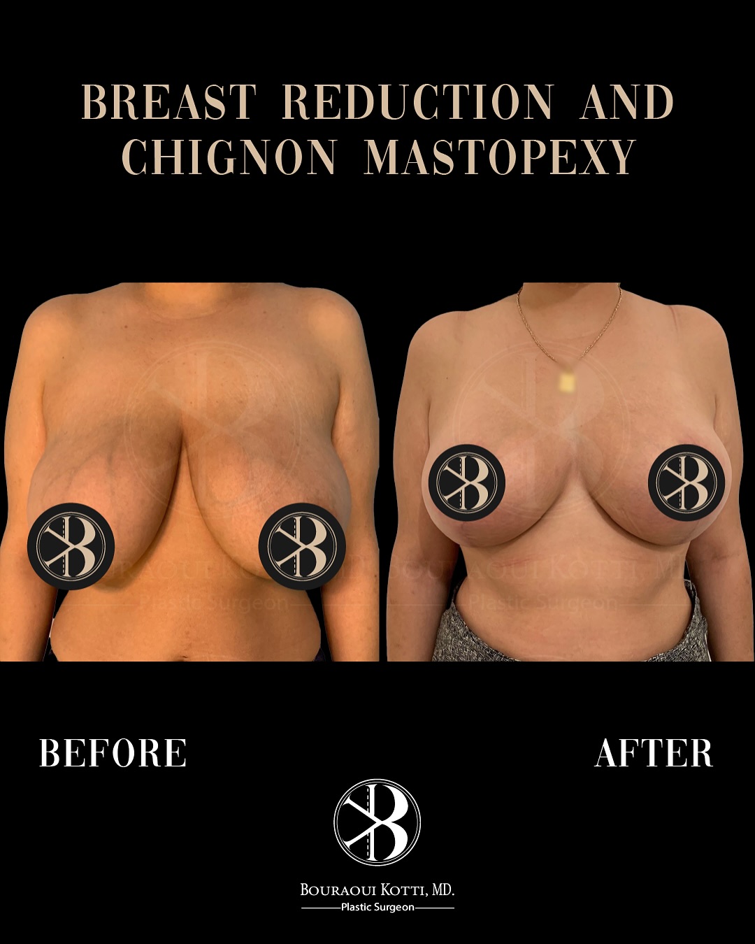 Breast Reduction Surgery in Dubai before and after clinical result