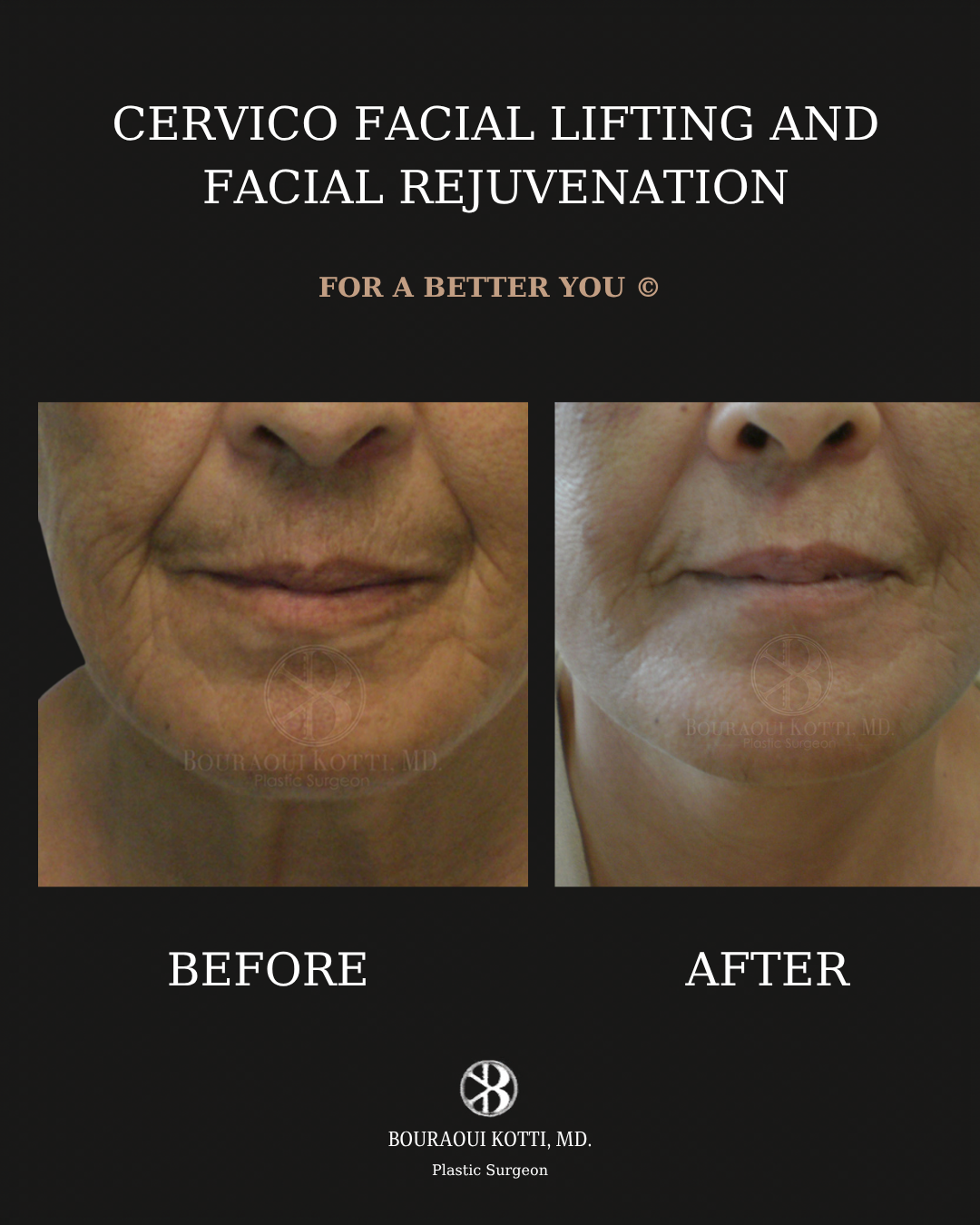 عملية شد الوجه before and after clinical result