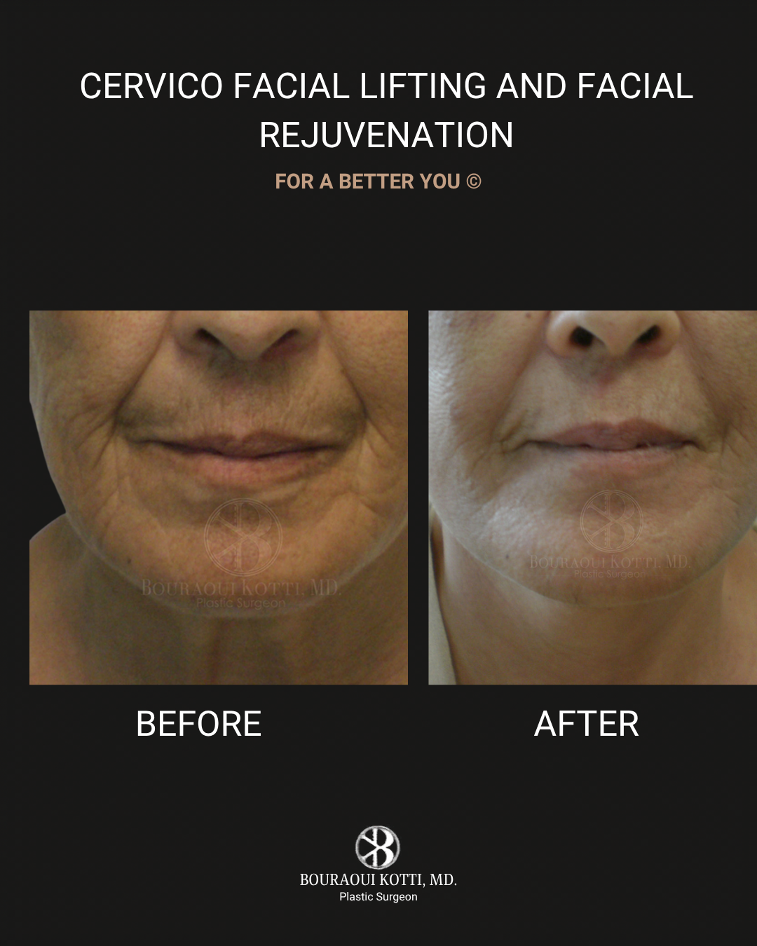 عملية شد الوجه before and after clinical result