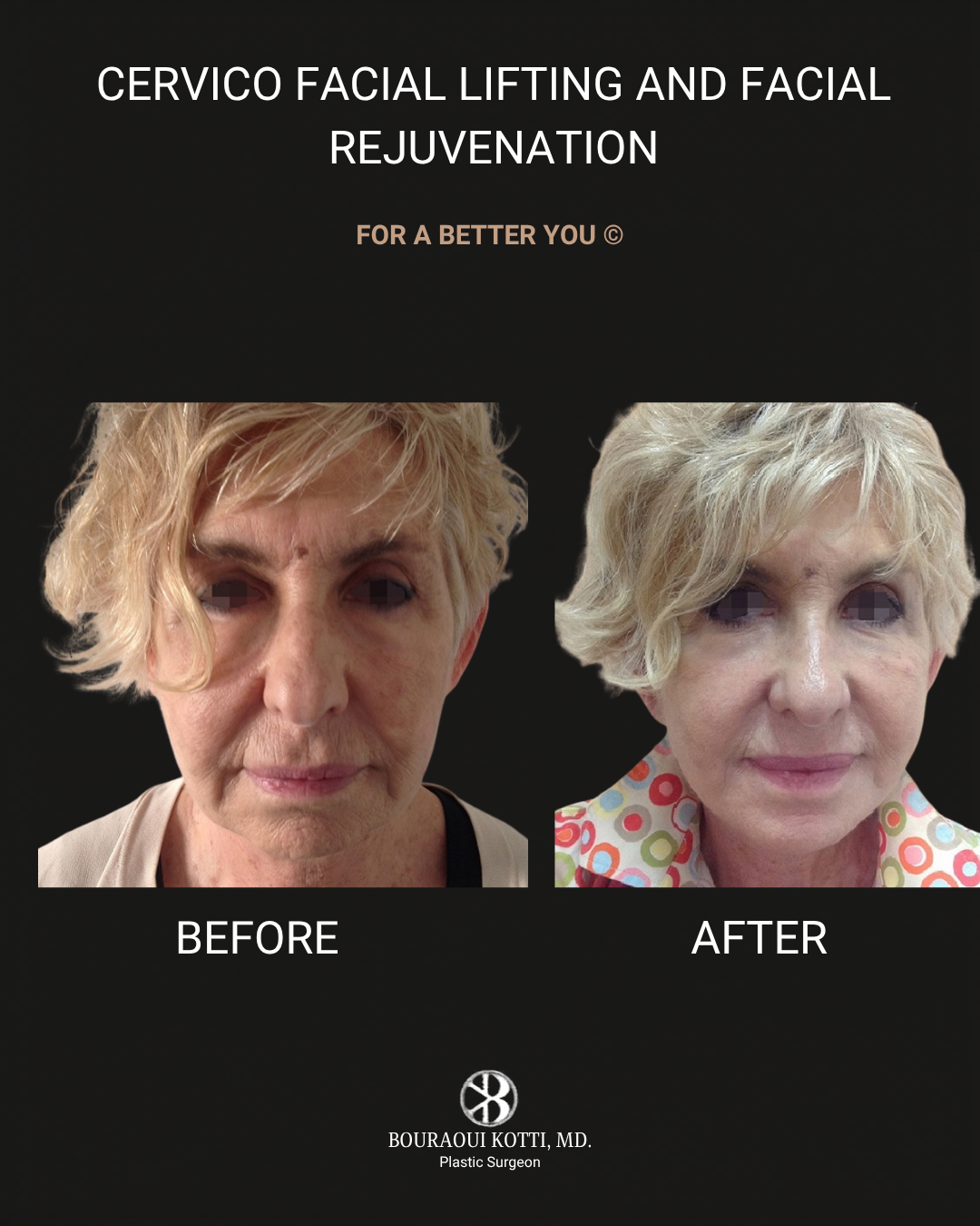 عملية شد الوجه before and after clinical result
