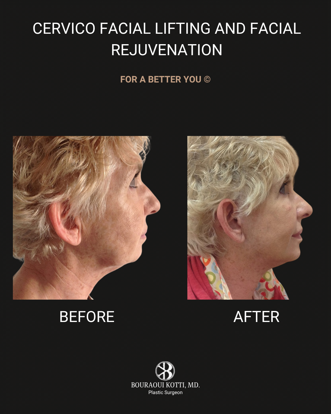 عملية شد الوجه before and after clinical result