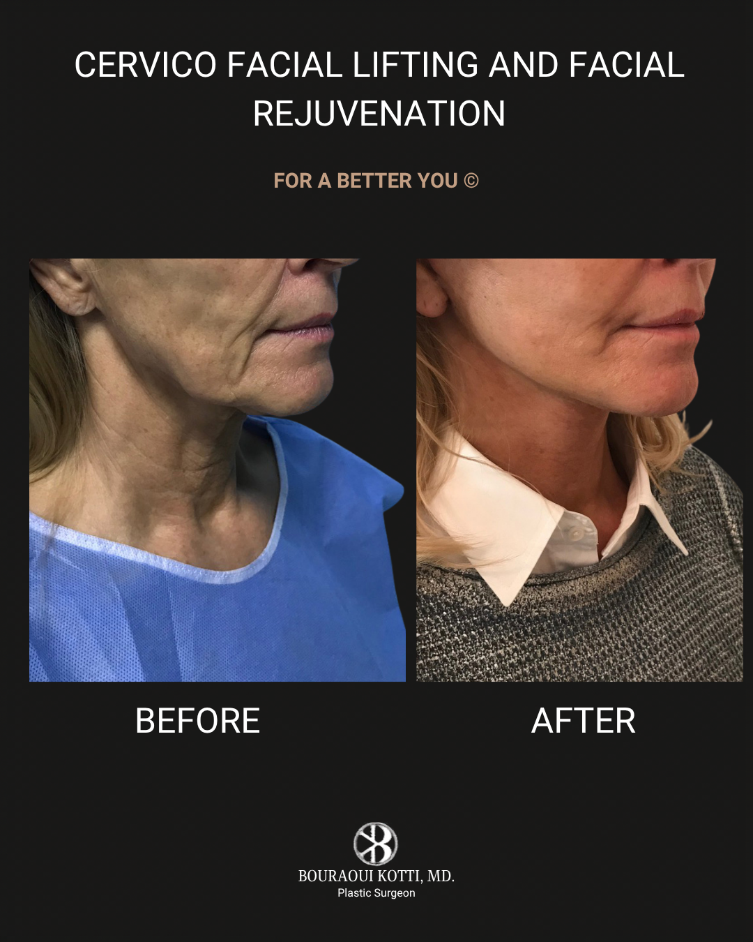 عملية شد الوجه before and after clinical result