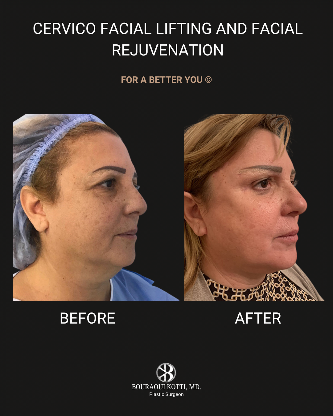 عملية شد الوجه before and after clinical result
