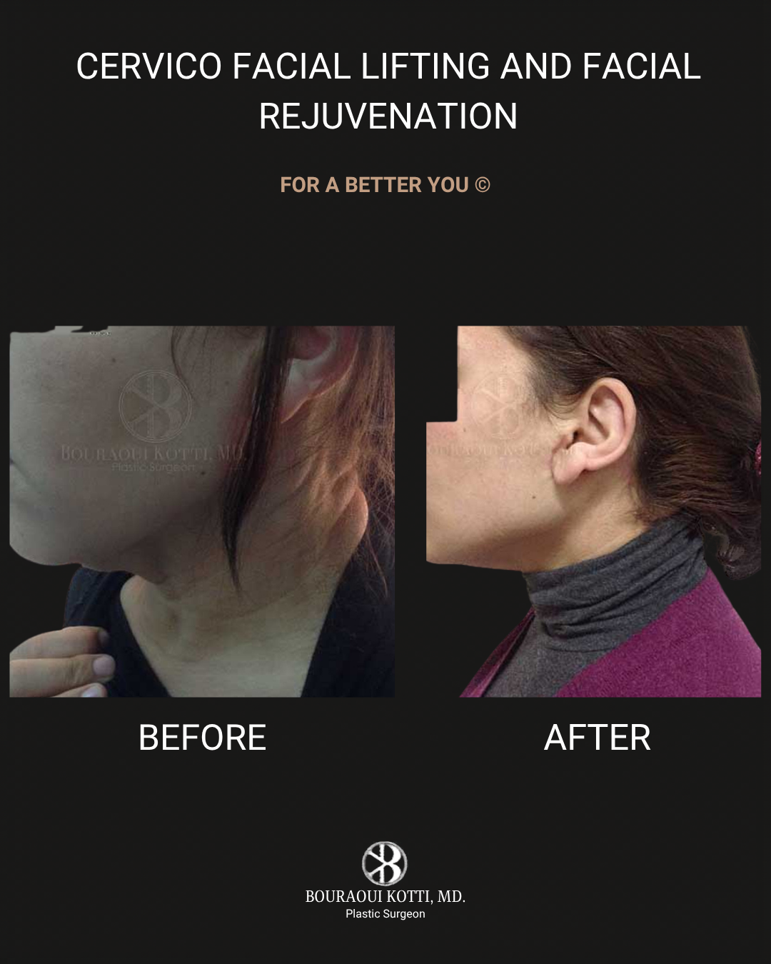 عملية شد الوجه before and after clinical result
